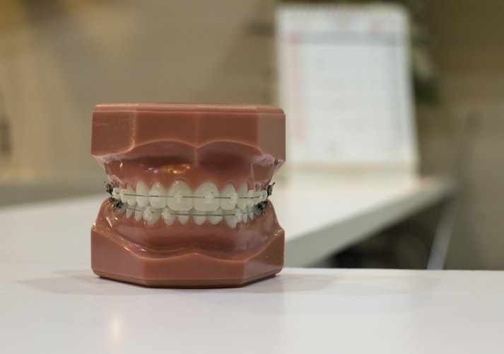 Blog Orthodontie verzekering - Blogs, tips en nieuws over verzekeringen
